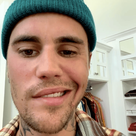 Justin Bieber leidet an Gesichtslähmung!